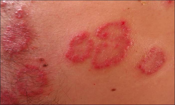 สะเก็ดเงิน เรื้อนกวาง Psoriasis การดูแล ป้องกัน ที่ต้นเหตุ